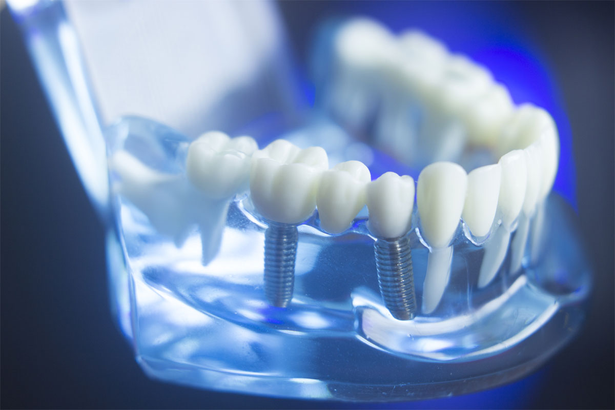 top 5 things one must know about dental implants