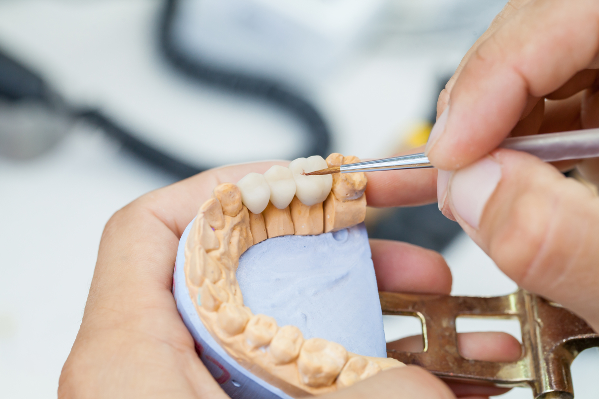 what are dental bridges, and what are the different types