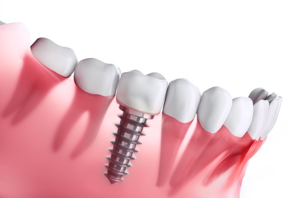 stages of dental implants — 5 steps to a beautiful smile