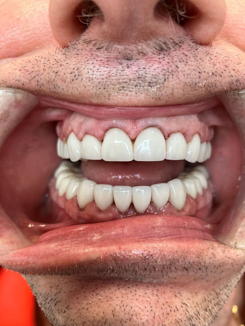 Smile Transformations Near Me in Indian Land, SC